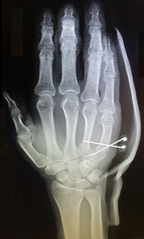 Broken Hand